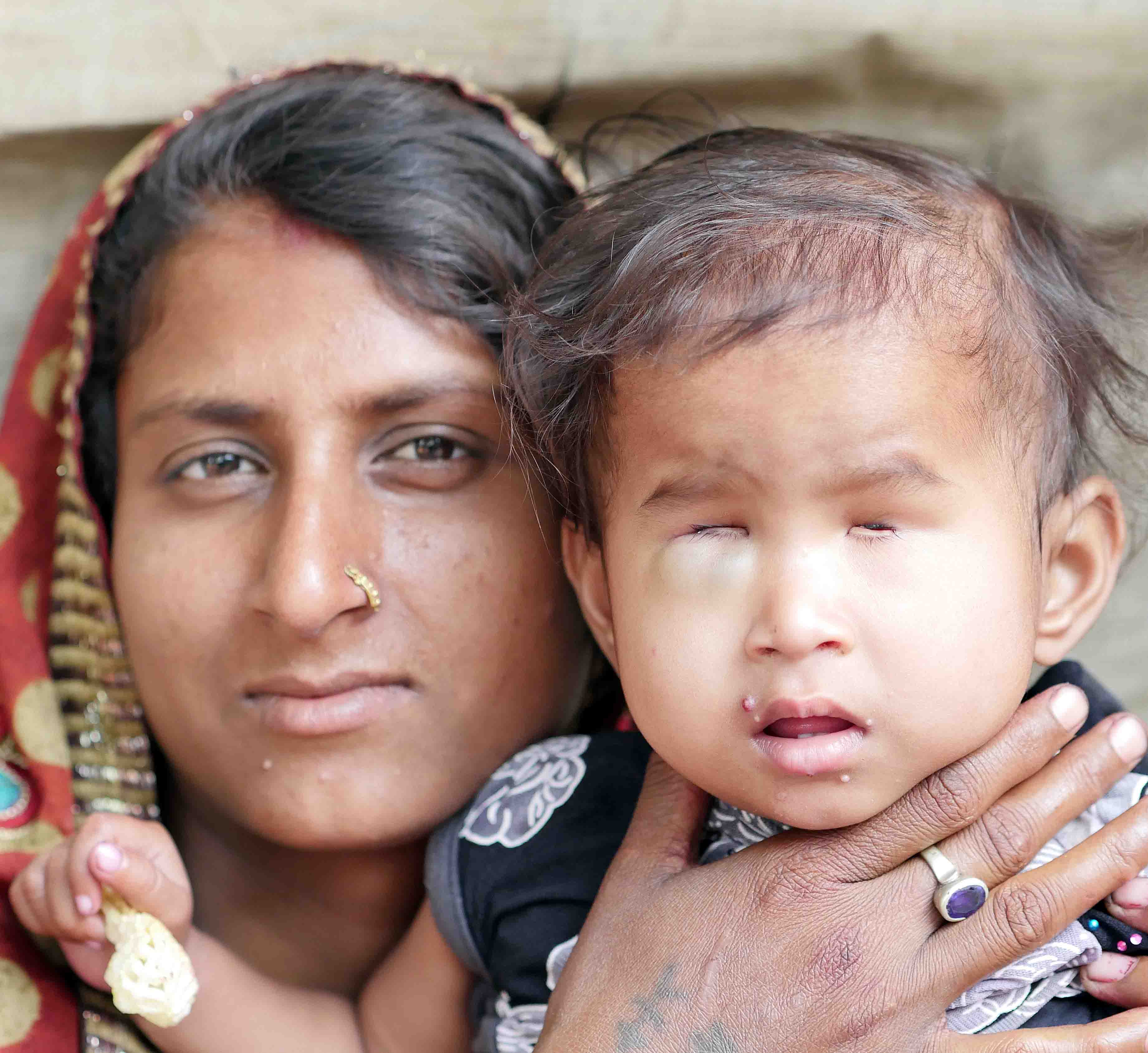 Jyoti’s eyeballs and eye openings had not formed properly.