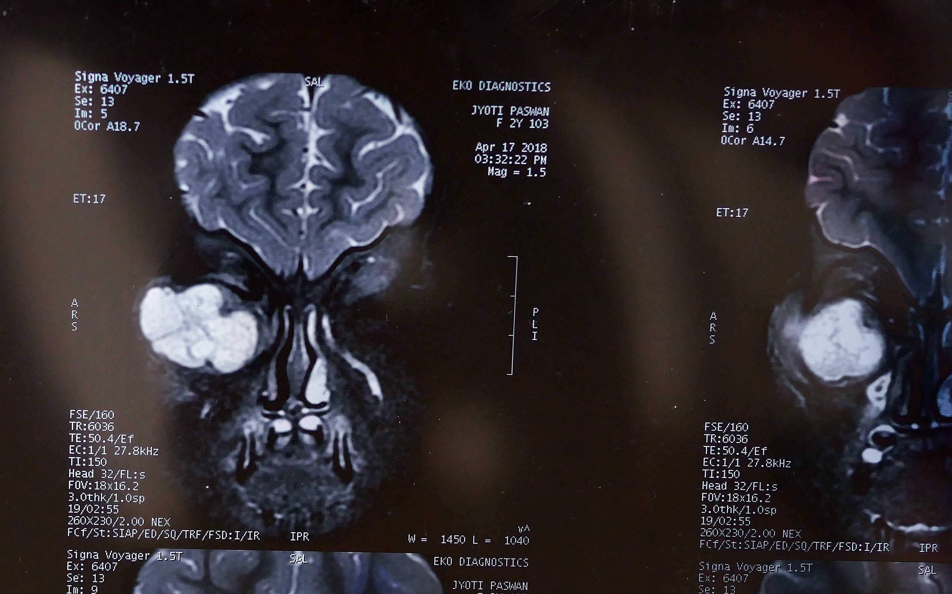 the-tumour-is-growing